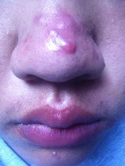 鼻子痤疮图片,成因、症状及防治策略